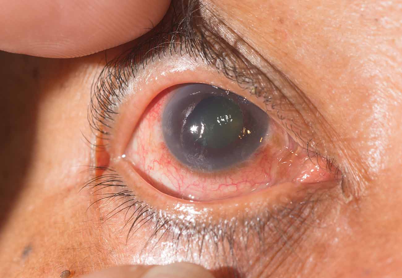 Glaucoma en México: un alto costo de atención y su impacto socioeconómico